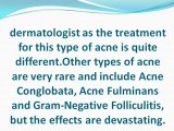 Different Acne Types Need Different Treatments