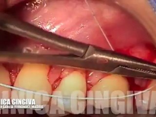 FREE GINGIVAL GRAFT WITH ALLODERM. CLINICA GINGIVA .DR JAVIER GARCIA FERNANDEZ