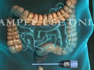 Appendicitis Surgery - Laparoscopic Appendectomy