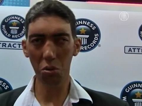 Самый высокий человек в мире перестал расти