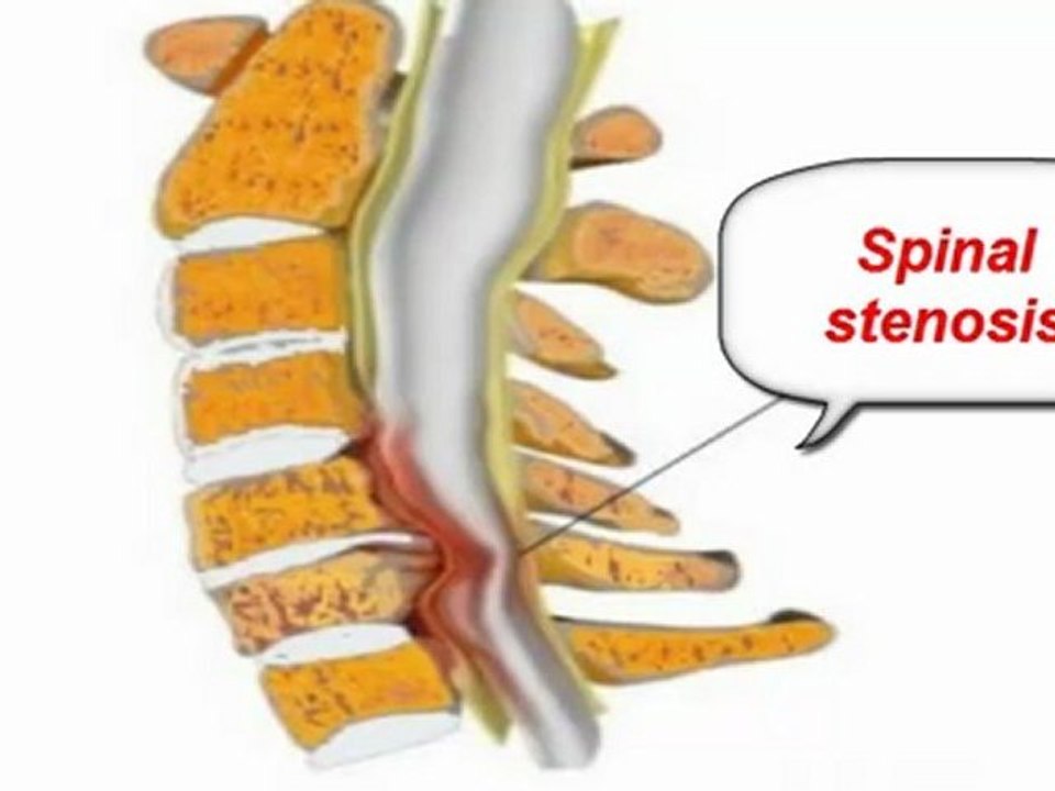 sciatica pain reliever - how to relieve pain from sciatica - sciatica pain in leg