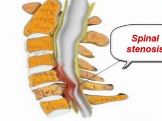 sciatica nerve location - sciatica nerve problems - medication for sciatica