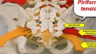 what are the symptoms of sciatica - what is sciatica symptoms