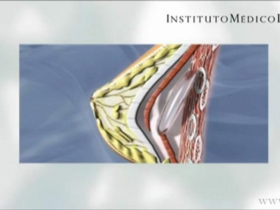Mamoplastia - Aumento de pecho en Madrid