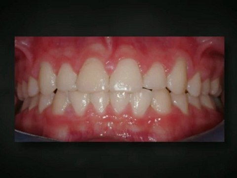 Littleton Orthodontist Apr2012