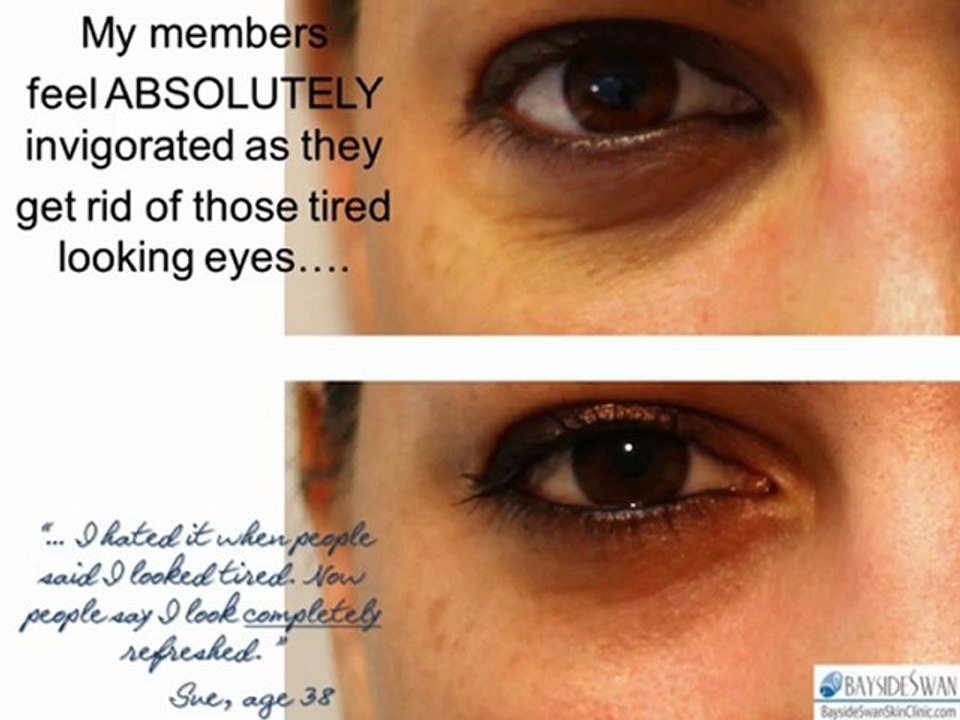 Bayside Swan Painless Beauty Peel. Offer ends June 21