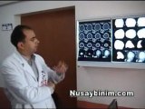 Mardin Nusaybin Devlet Hastanesi'nde Op. Dr. Umut Yaka ve ekibi tarafından yapılan Nusaybin'in ilk beyin ameliyatı