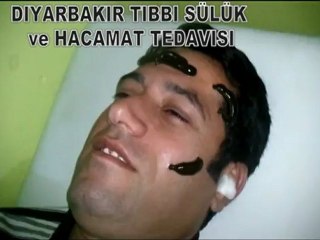 Kürt Yazar Hogır BERBIR Sinüzit Tedavisi