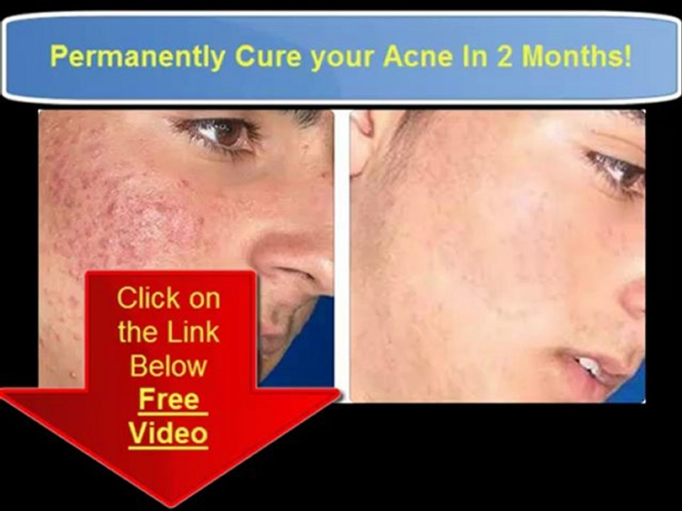 Best Overnight Acne treatment Best Homemade acne treatment