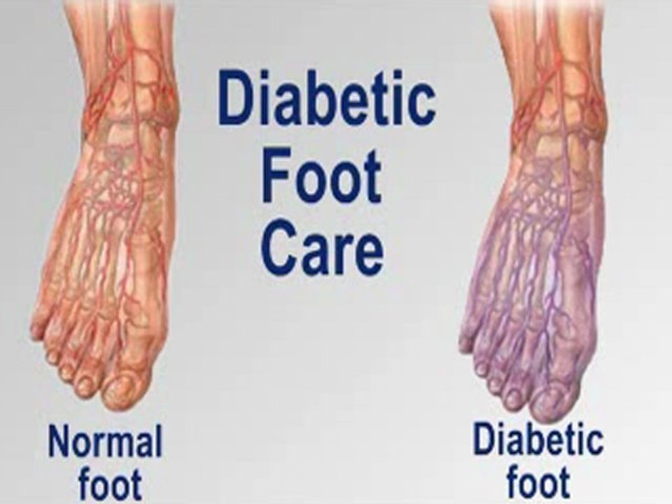 Diabetic Foot Care - Podiatrist in Massapequa and Nassau County, NY