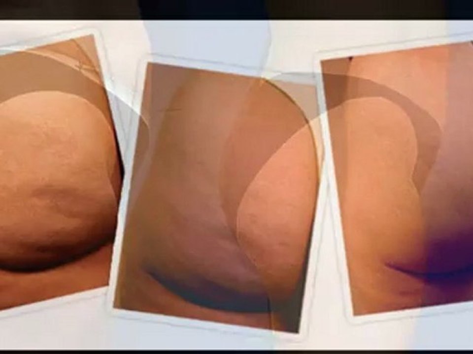 Cómo Eliminar celulitis de piernas, muslos y glúteos
