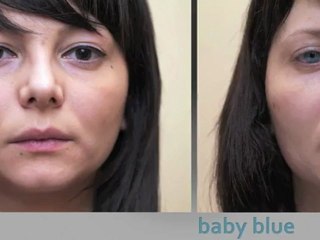 Italian patient surgically changes her eye color from brown to blue with brightocular