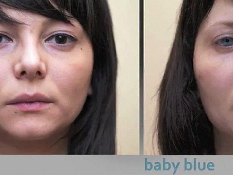 Italian patient surgically changes her eye color from brown to blue with brightocular