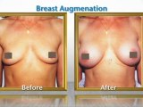 Breast Augmentation – Plastic Surgeons Serving San Diego/La Jolla