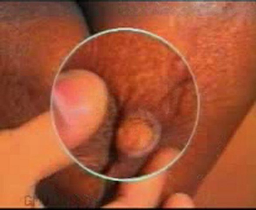 Examination of ULCER