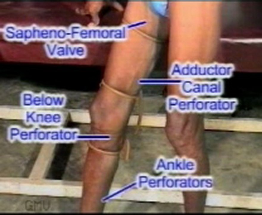 Examination of varicose vein