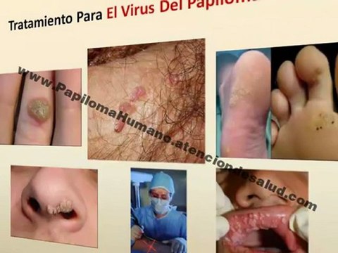 Virus Del Papiloma Humano Tratamiento