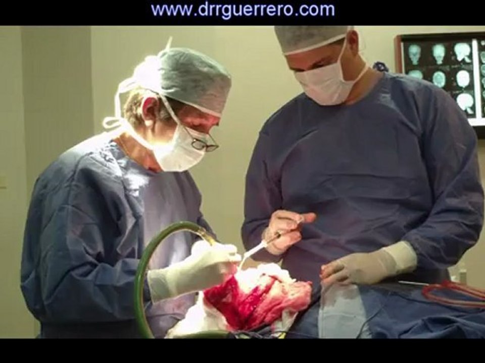 Ecuador CRANEOSINOSTOSIS  CRANIOSYNOSTOSIS Dr Guerrero