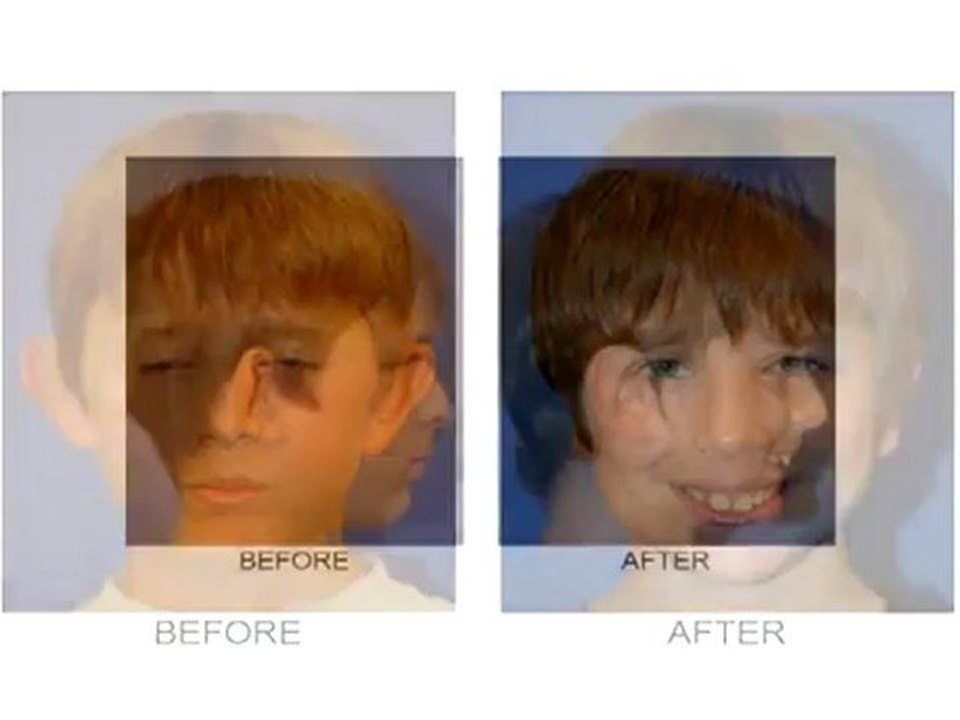 Facelift Newport Beach