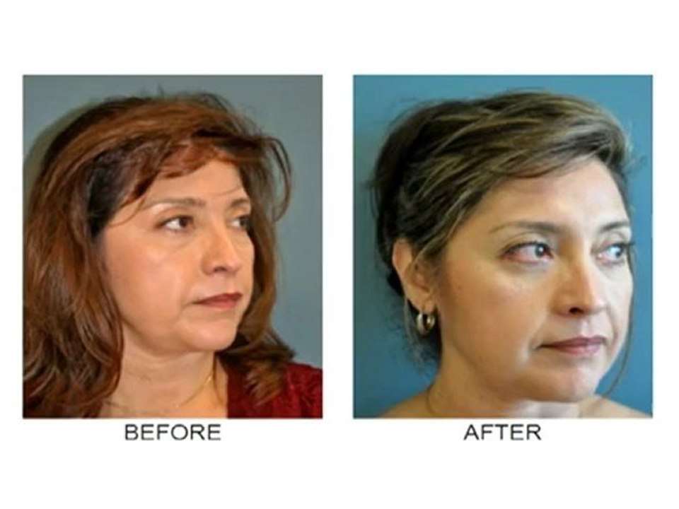Facelift Newport Beach