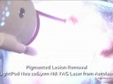Pigmented Lesion Laser Removal by Aerolase