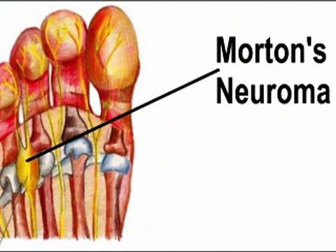 Morton’s Neuroma - Podiatrist in Scottsdale and North Scottsdale AZ