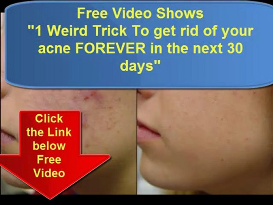 Acne Holistic Treatment Secrets holistic treatment for Acne