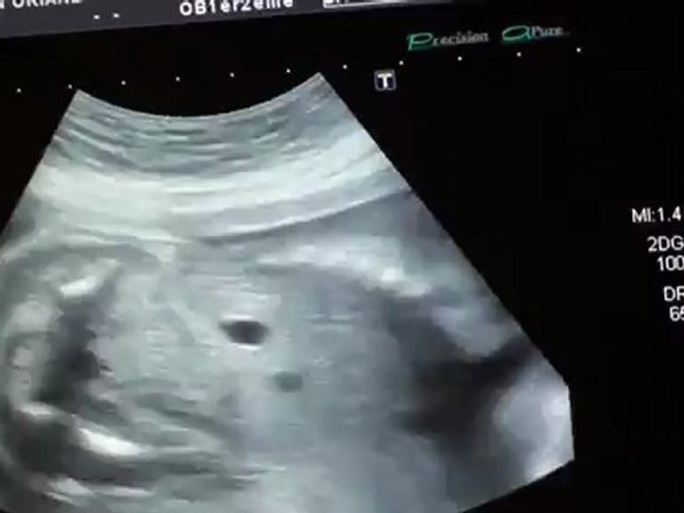 GEOFFREY 2 EME ECHOGRAPHIE