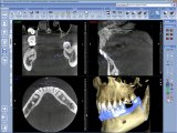 3D Module Superimposing Impression With CBCT