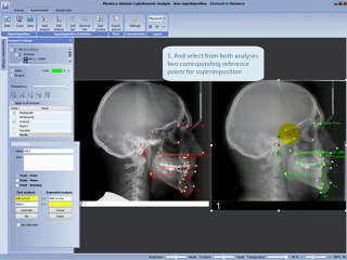 Cephalometric Analysis Making Superimposition Of Analyses