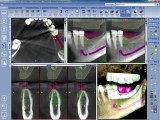 Planificar Implantes 3D con Coronas