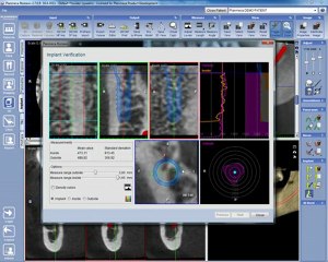 Planificar Implantes 3D