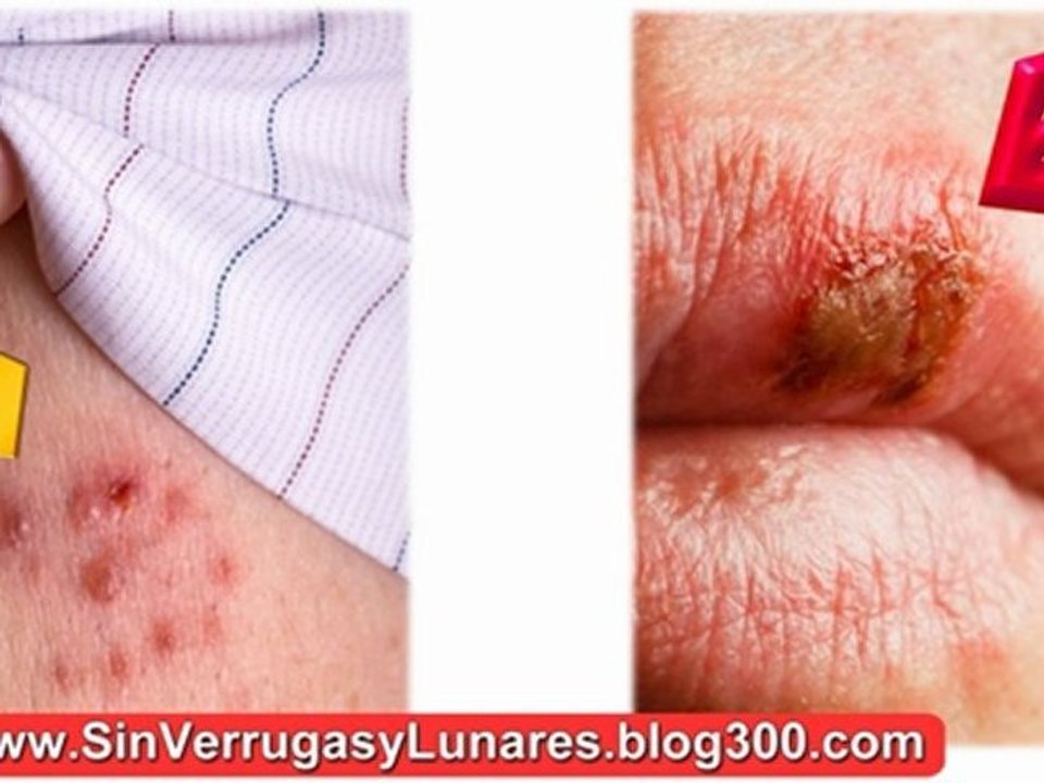 Como Eliminar Lunares - Como Quitar Los Lunares - Como Curar Las Verrugas