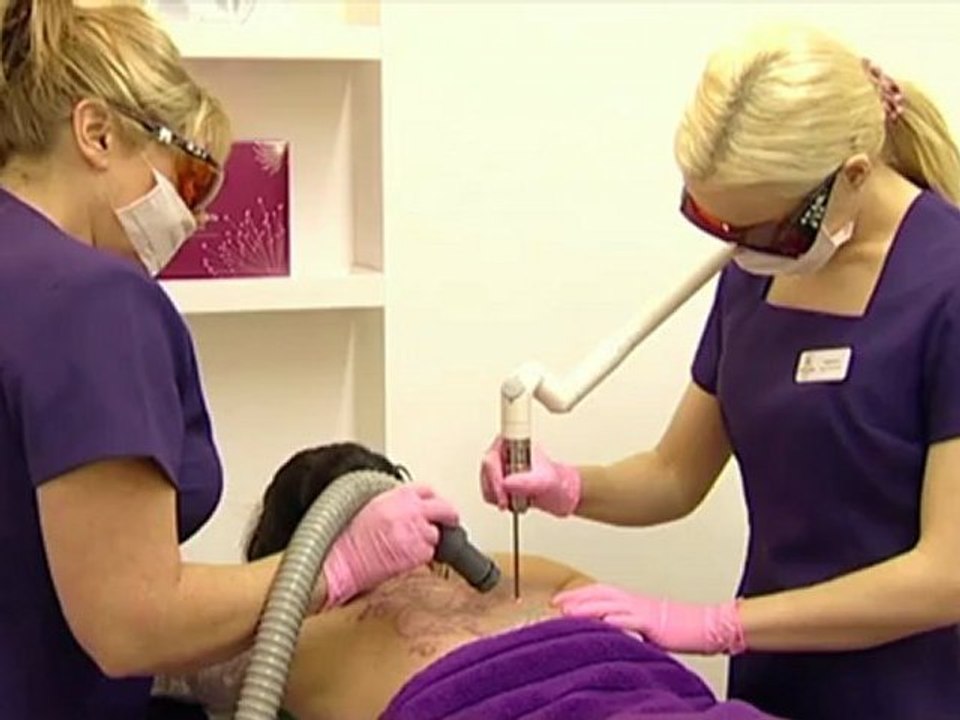 Tattoo Removal | Laser Tattoo Removal Video