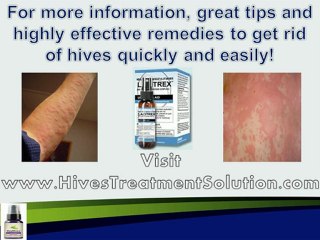 Natural Hives Treatment