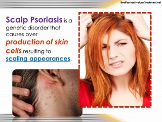 Simple Guide in Psoriasis Scalp Treatment