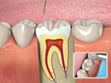 Diş Evi Kanal Tedavisi nasıl yapılır?