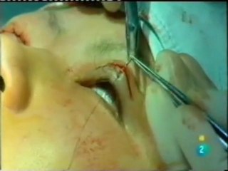 China: Belleza occidental (Cirugia de parpados)