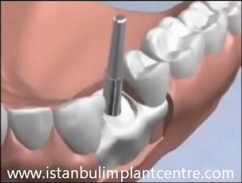implant nedir , implant videosu , diş amelyatı nasıl yapılır ( istanbulimplantcentre.com )