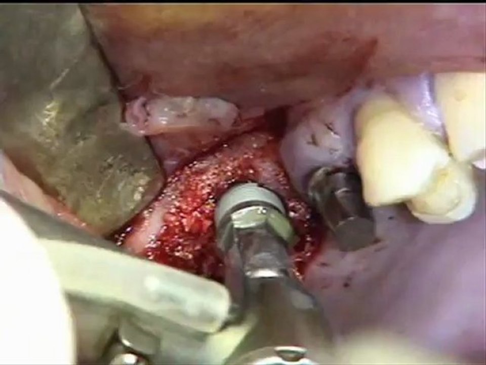 Implants dentaires - Chirurgie : pose d'un implant en Technique "Tulip" - CAS JUIN 2011 - Drive