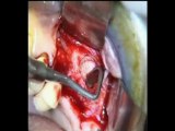 Implants dentaires - Chirurgie : Sinus lift et Substitut osseux - CAS SEPT 2011 - Drive implants