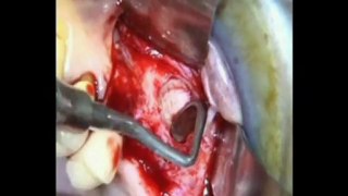 Implants dentaires - Chirurgie : Sinus lift et Substitut osseux - CAS SEPT 2011 - Drive implants