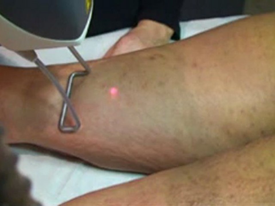 epilation laser definitive peau metisse et noire