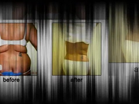 Liposuction Surgery Virginia Beach - Before and After Photos Liposuction Surgery