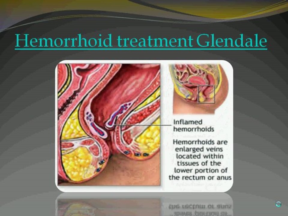 New Hemorrhoid Treatment in Los Angeles