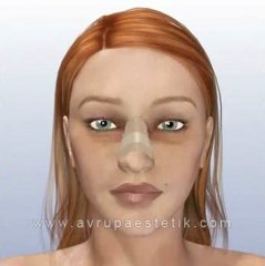 Burun Estetigi Ameliyatı