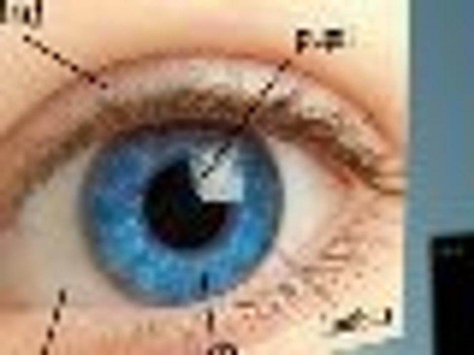 Iris Lasik