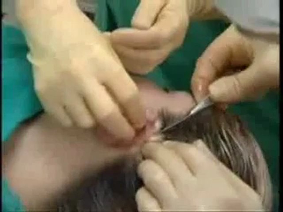 İple Kepçe Kulak Estetiği