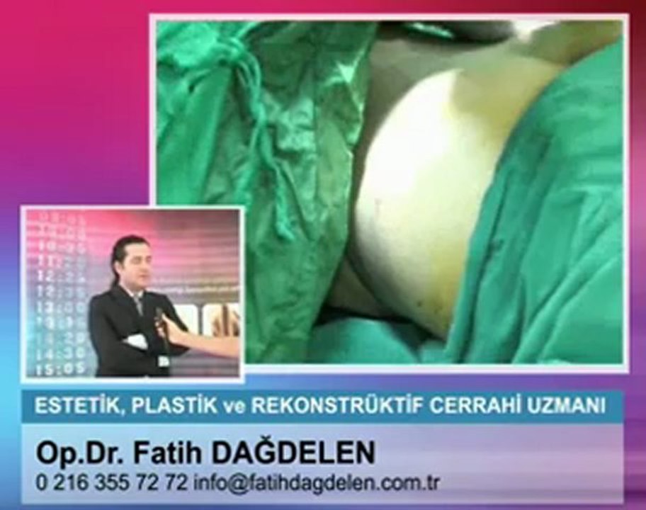 Liposuction - Liposakşın Nedir ?