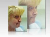 Face Lift Before and After Virginia Beach - Plastic Surgery of Virginia Beach